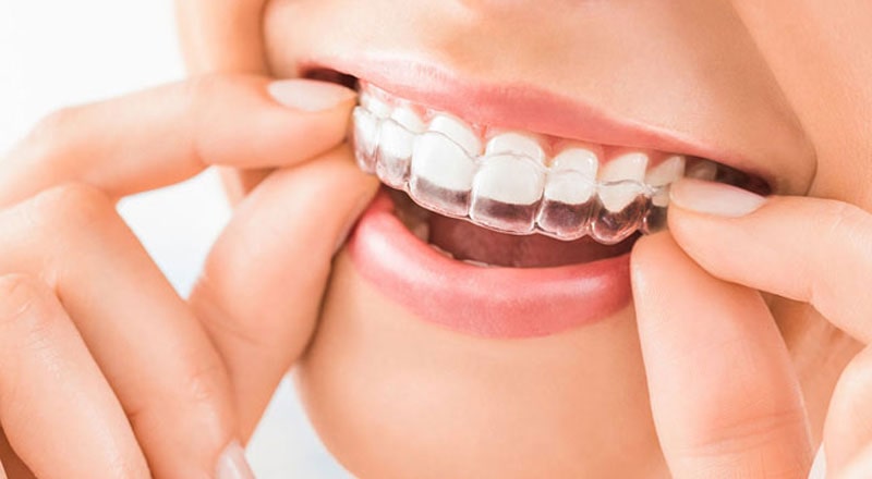 Invisalign Treatment